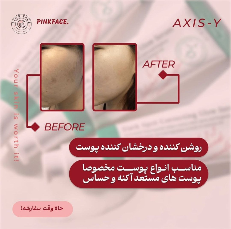 ضد لک اکسیس وای