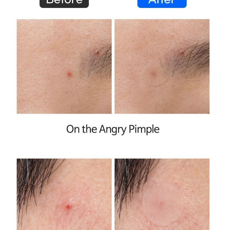 تأثیر قبل و بعد چسب ضد جوش تیام