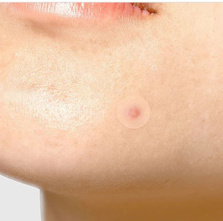 چسب ضد جوش تیام